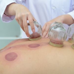 cupping-news