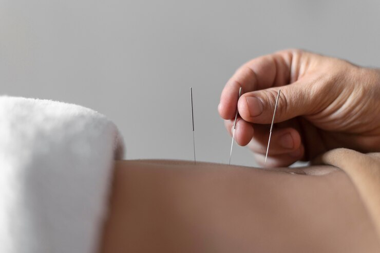 Chinese Acupuncture