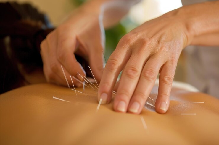 Traditional Chinese Acupuncture