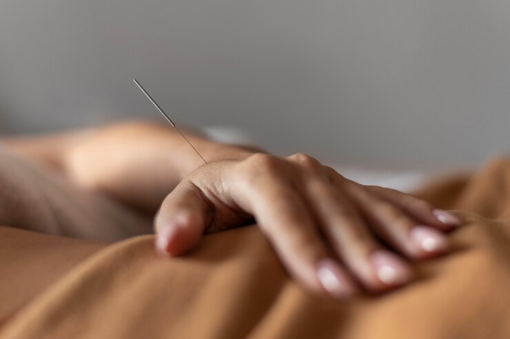 Fertility Acupuncture