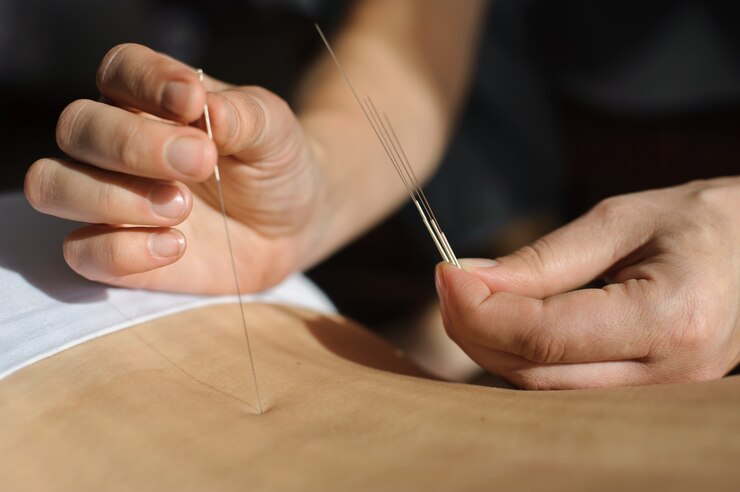 acupuncture-chinese-medicine-treatmen_191163-18