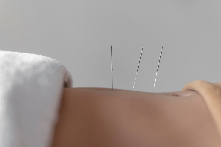 accupuncture